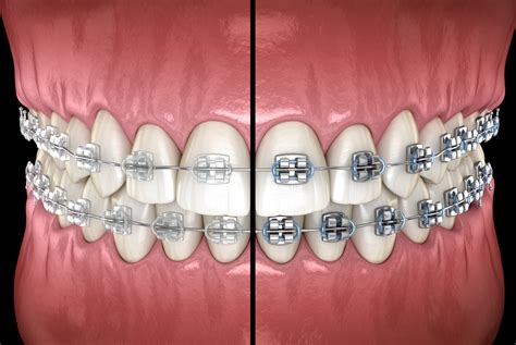 brackets porcelana vs metal|ceramic vs metal braces.